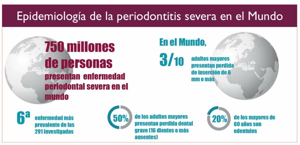 periodontitis severa